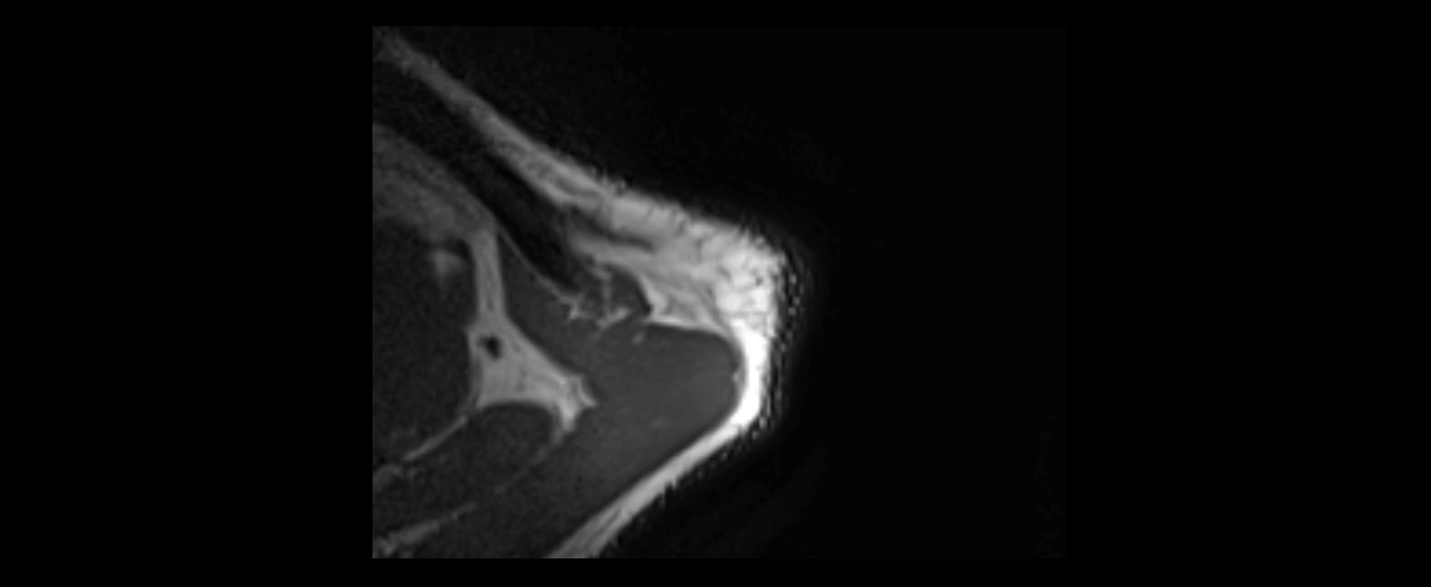 shoulder ligaments axial 3d 3t mri image-img-00005-00010.webp